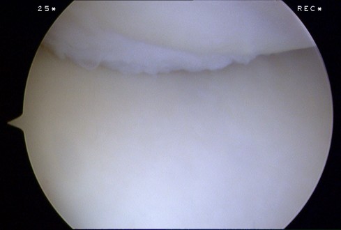 DeNovo NT cartilage graft on the undersurface of the patella.